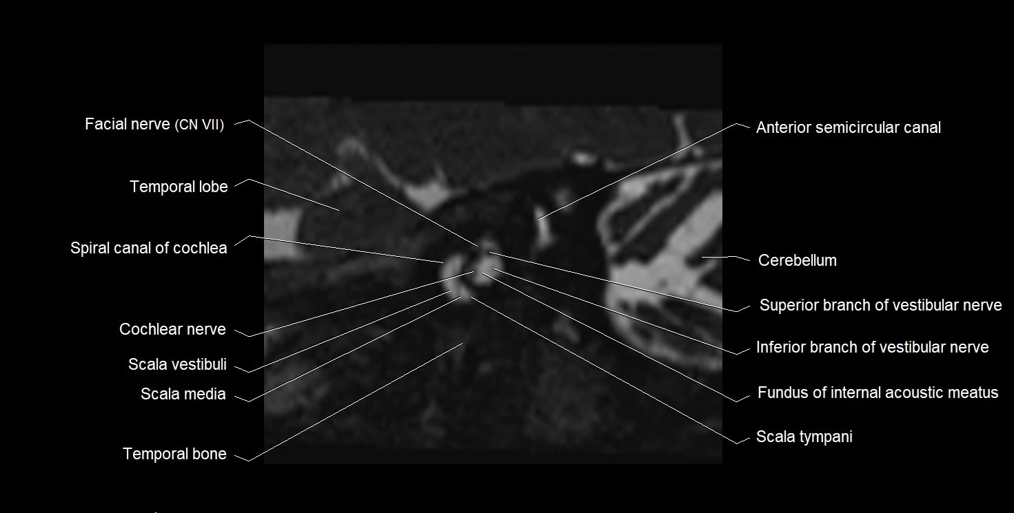 Internal auditory meatus (IAM) 3T sagittal cross sectional anatomy image 12.webp